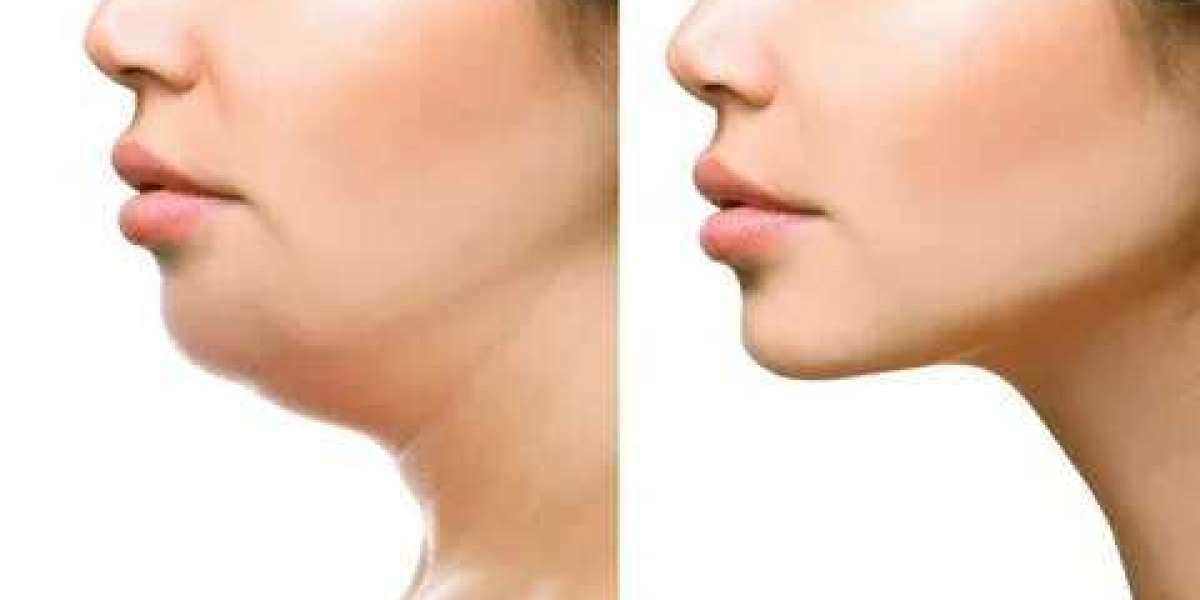 Coolsculpting Chin Swelling